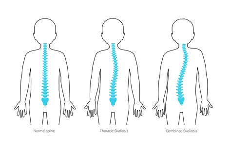 Scoliosis Symptoms and treatment - little growing bones