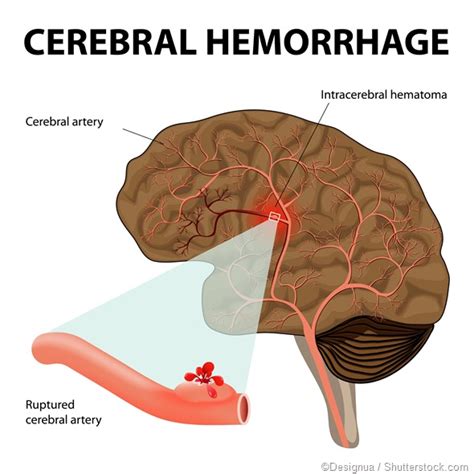 Subarachnoid Hemorrhage Vs Intracerebral Hemorrhage