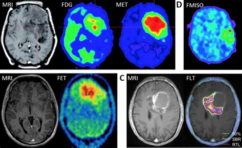 Mri Scan Brain Tumor