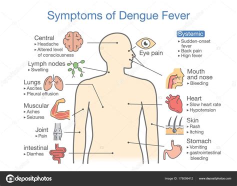 デング熱患者の症状です 健診の図について図 Stock Vector by ©solar22 178099412