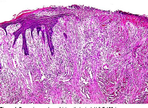 Figure 3 from PYOGENIC GRANULOMA Definition Pyogenic granuloma (PG) is ...