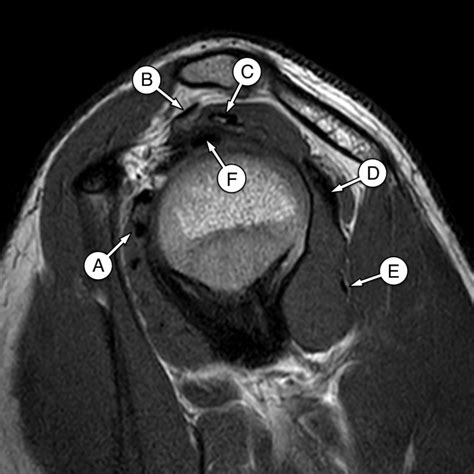 Coracohumeral Ligament Mri