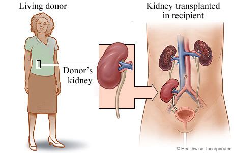 Transplant » Division of Nephrology, Hypertension & Renal Transplantation » College of Medicine ...