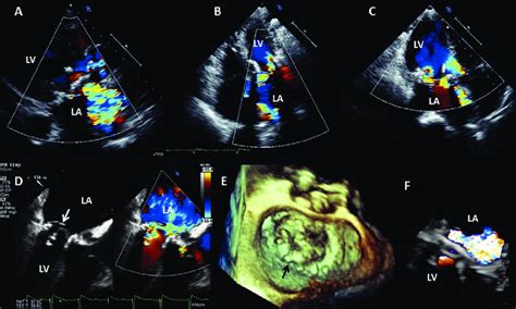 Bioprosthetic mitral valve with severe regurgitation due to valve... | Download Scientific Diagram