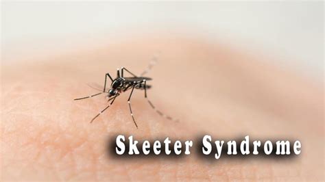 Skeeter Syndrome | See What A Mosquito Can Do?