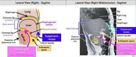 #Pouch Hepatorenal recess (Morrisons pouch) in sub-hepatic space ...