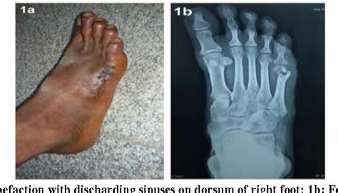 [PDF] The Madura Foot: A case of eumycotic mycetoma on histopathology ...