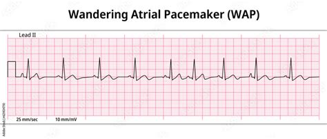 ECG Wandering Atrial Pacemaker (WAP) - 8 Second ECG Paper - Electrocardiography Vector Medical ...