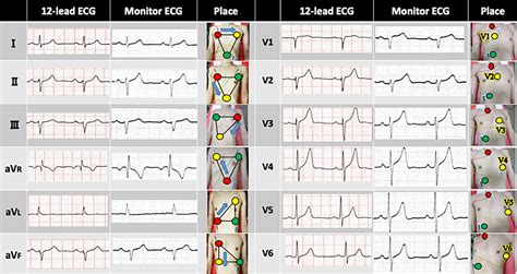 Ecg Leads