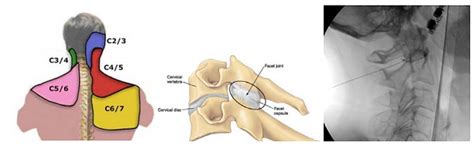 Cervical Facet Injection | New England Spine Care | Spine Center| Cambridge