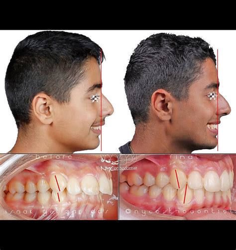 Before And After Overjet Profile