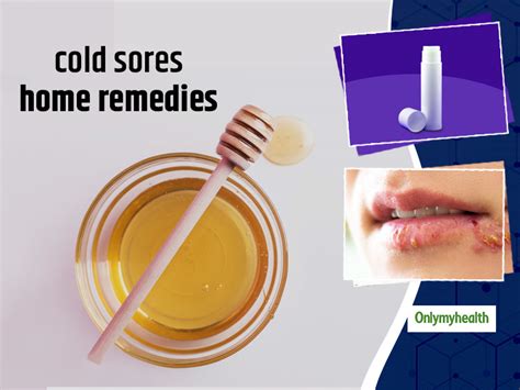 Useful Home Remedies To Get Rid Of Fever Blisters Or Cold Sores | OnlyMyHealth