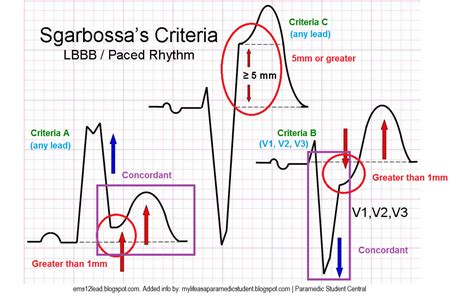 Paramedic Student Central: Sgarbossa’s Criteria