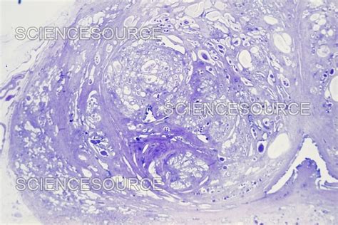 Photograph | Prostatic Hyperplasia, LM | Science Source Images