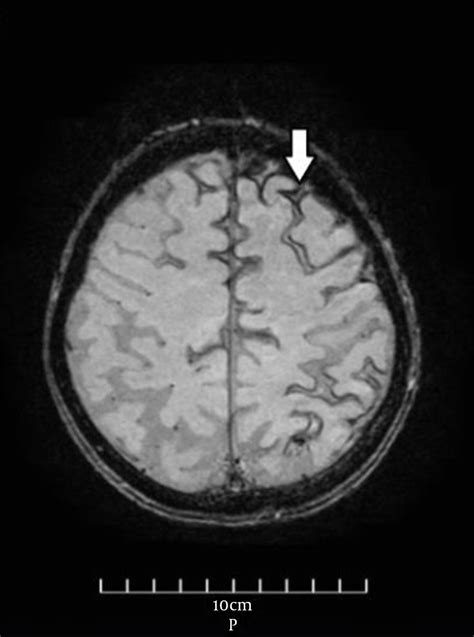 Brain MRI (susceptibility-weighted image sequence) shows linear ...