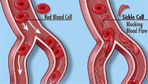 VIDEO: World Sickle Cell Day: does the UK's biggest blood disorder get enough airtime?