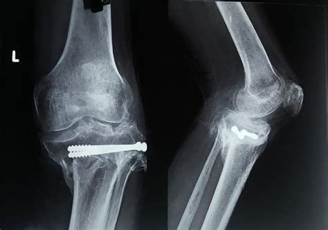 Total Knee Replacement (TKR) Using Stryker Triathlon System - Dr. Chethan Nagaraj