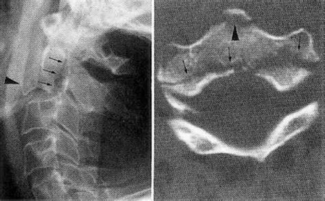 C2 Fracture Radiology