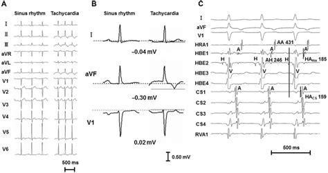 Figure 1 from Differentiation of Slow-Slow Form of AVNRT from AVRT through a Posteroseptal ...