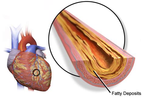 Coronary artery disease - Wikipedia