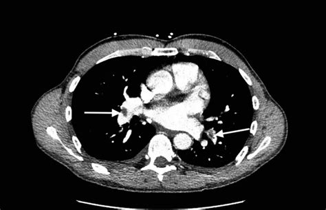 Cureus | Acute Pulmonary Embolism in a Healthy Male With Elevated Lipoprotein(a)