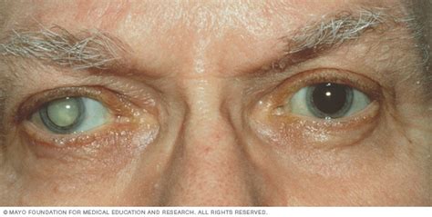 What a cataract looks like - Mayo Clinic