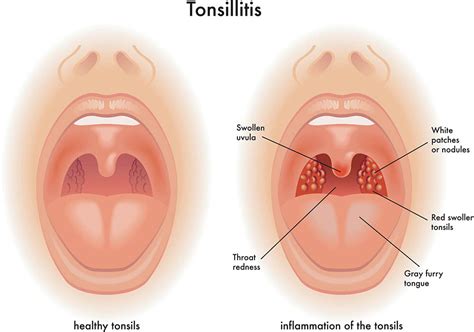 Swollen Lymph Nodes Neck Strep Throat