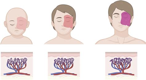 Frontiers | GNAQ mutations drive port wine birthmark-associated Sturge-Weber syndrome: A review ...