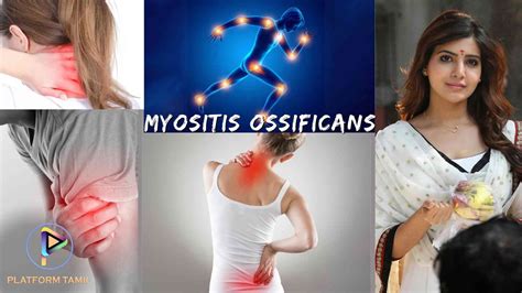 Myositis Symptoms and Types: மயோசிடிஸ் எனும் அரிய நோய் பற்றிய விவரங்கள் - Platform Tamil ...