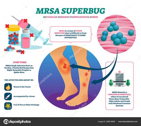 MRSA Super Bug Vector Labeled Staph Infection Explain Stock Illustration By ©VectorMine ...