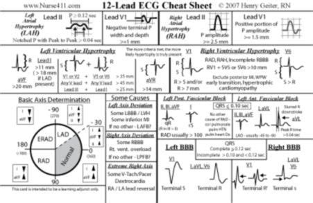 12 Lead EKG MI Interpretation mnemonics | Put mouse over Cheat Sheet ...