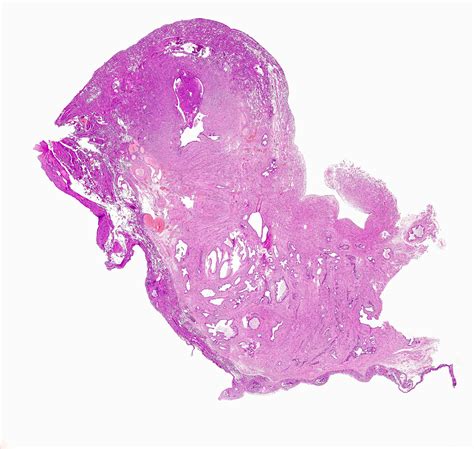 Pathology Outlines - Salpingitis isthmica nodosa