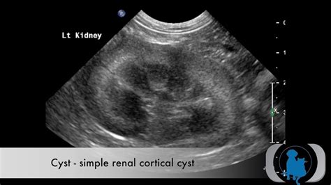 Ultrasound of a simple renal cortical cyst | Renal, Cysts, Kidney cyst