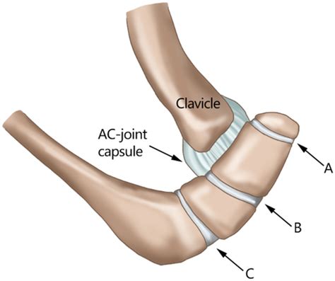 Os Acromiale: Reviews and Current Perspectives - You - 2019 - Orthopaedic Surgery - Wiley Online ...