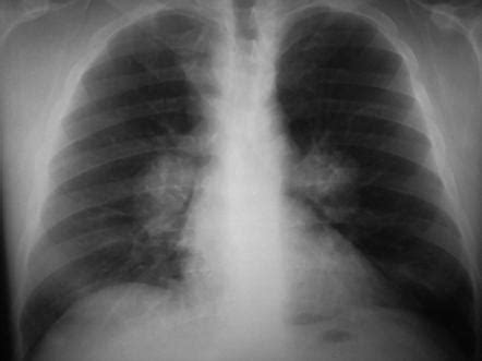 Bilateral hilar lymph node enlargement | Radiology Reference Article | Radiopaedia.org