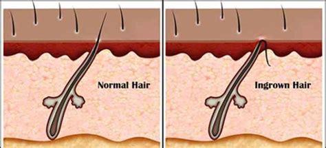 Ingrown Armpit Hair, Lymph Node, Pictures, Lump, How to Get Rid Home Remedies, Symptoms ...