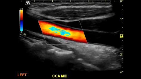 Normal Carotid Duplex - YouTube