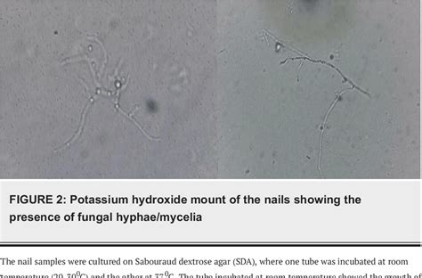 Figure 1 from Total Dystrophic Onychomycosis of All the Nails Caused by Non-dermatophyte Fungal ...