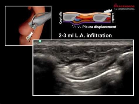 ULTRASOUND GUIDED INTERCOSTAL NERVE BLOCK - YouTube