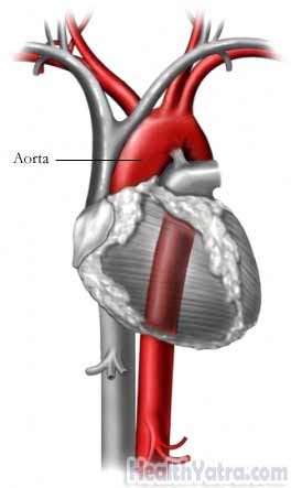 Aortic Coarctation Adult Definition, Causes, Symptoms, Complications ...