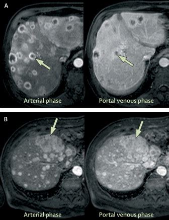 Abdominal MRI advances in the detection of liver tumours and ...