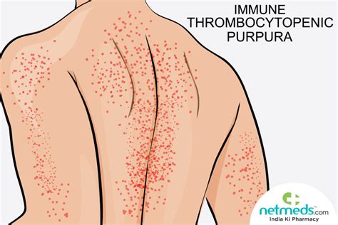 Immune Thrombocytopenia: Causes, Symptoms And Treatment