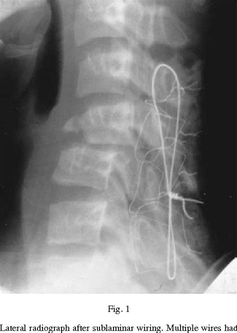 soft tissue swelling | Semantic Scholar