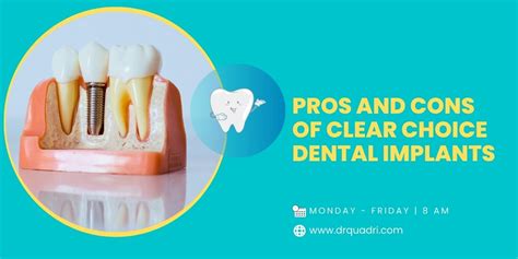 Clear Choice Dental Implants: Pros and Cons