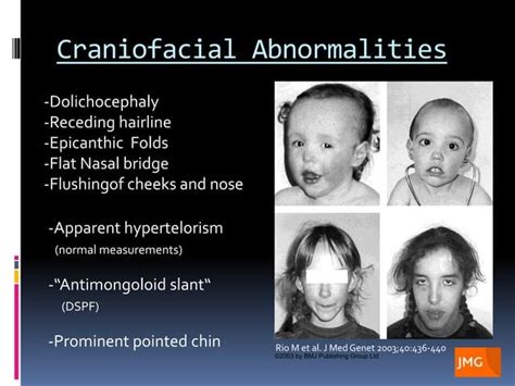 Sotos syndrome, Genetics, Radiology, Craniofacial Abnormalities ...