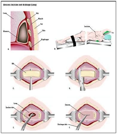 Incision And Drainage Of Superficial Perineal Abscess Cpt Code - Best Drain Photos Primagem.Org