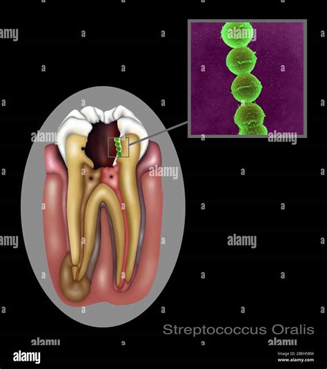 Oral Infection of Streptococcus Oralis Stock Photo - Alamy