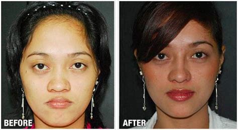 Before & After Rhinoplasty - Enhancements Cosmetic Surgery ...