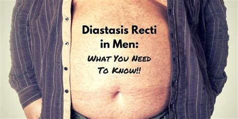 Diastasis Recti in Men: What is Diastasis Recti? | Diastasis recti, What is diastasis recti ...