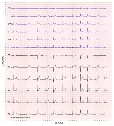 Ecg Showing Atrial Fibrillation With New St Elevation In The Inferior - Bank2home.com